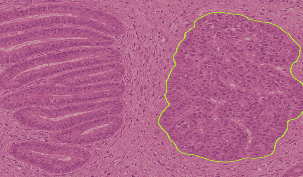 ColorectalHisto AI