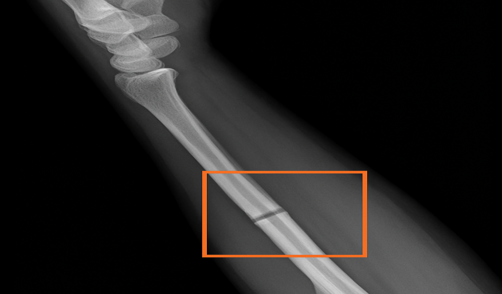 FracX-ray AI